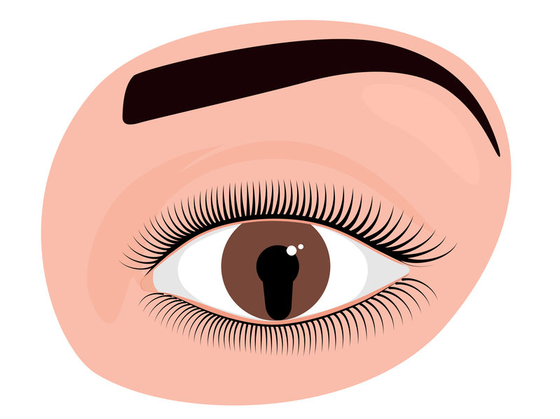 O que é coloboma ocular?