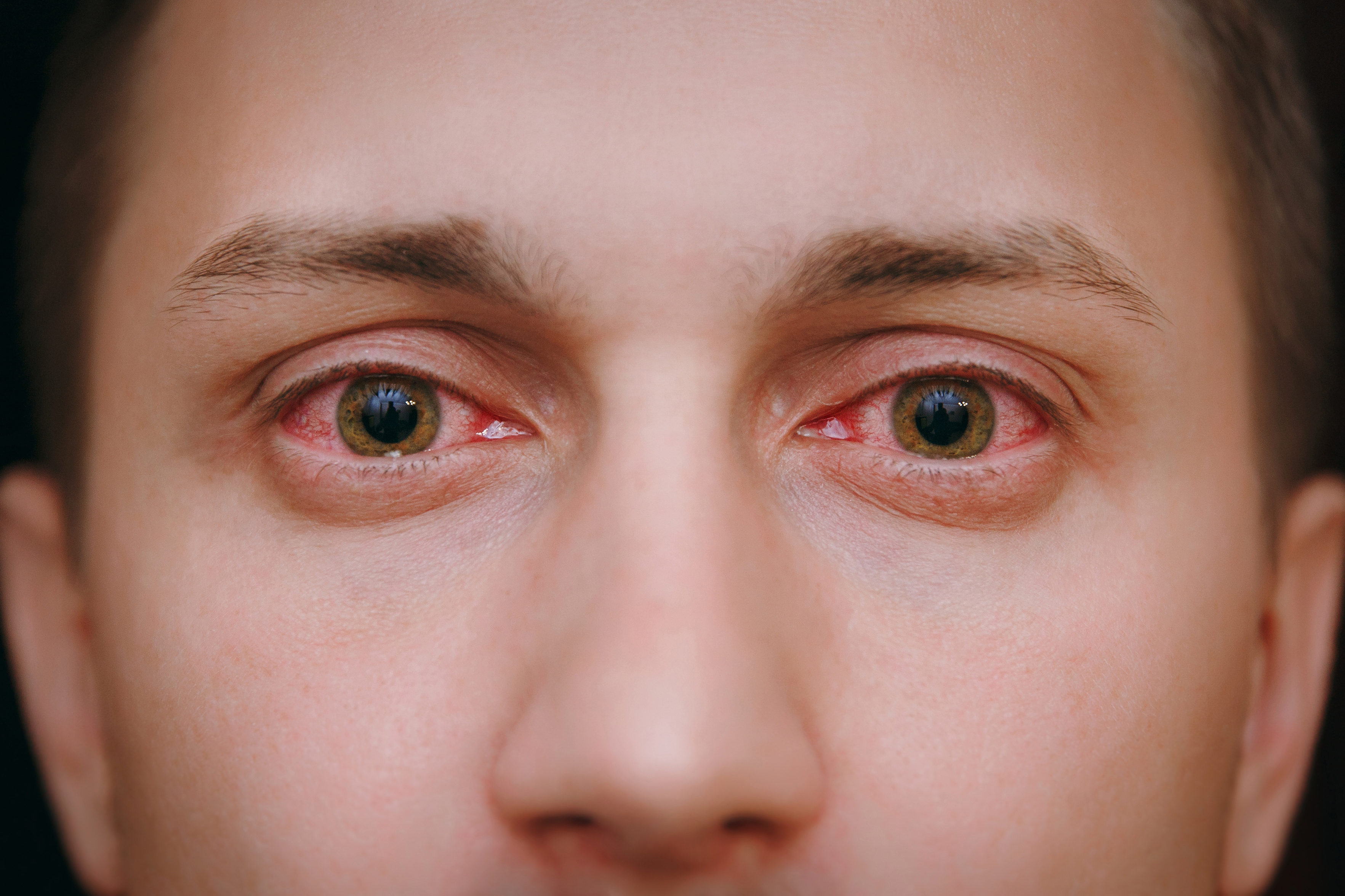 Olho vermelho: saiba quando procurar o oftalmologista