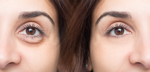 Rejuvenescimento facial: a importância dos olhos para um rosto jovial