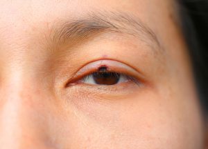 Melanoma ocular